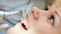 Limpeza Dental – Dentes Realmente Limpos